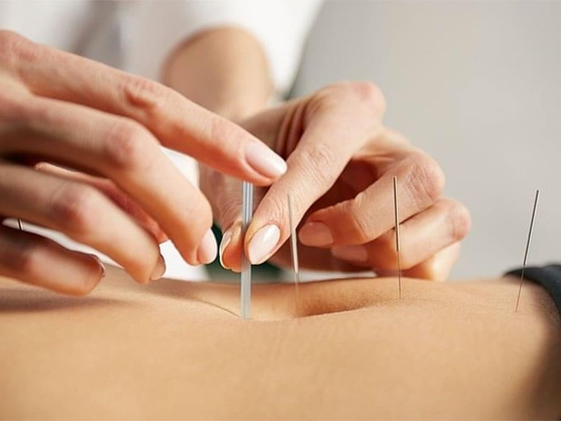 Acupuntura Estética Abdominal Barcelona - Acupuntura Estética Estrias