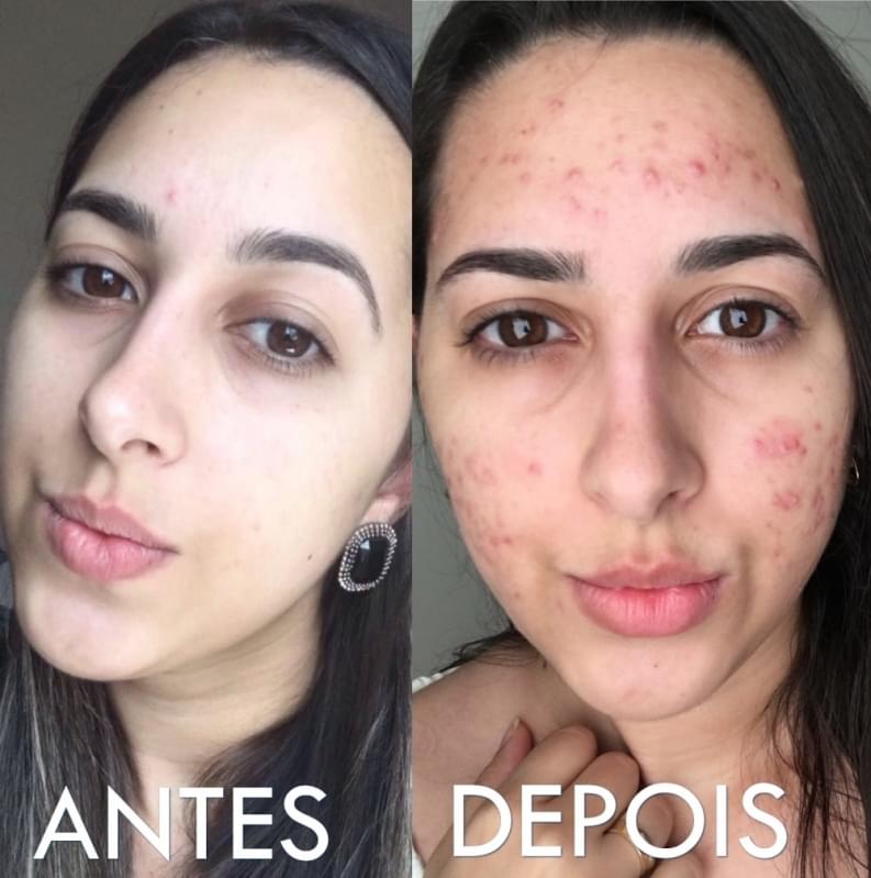 Acupuntura Estética Acne Preço Quinta da Paineira - Acupuntura Estética Redução Abdominal