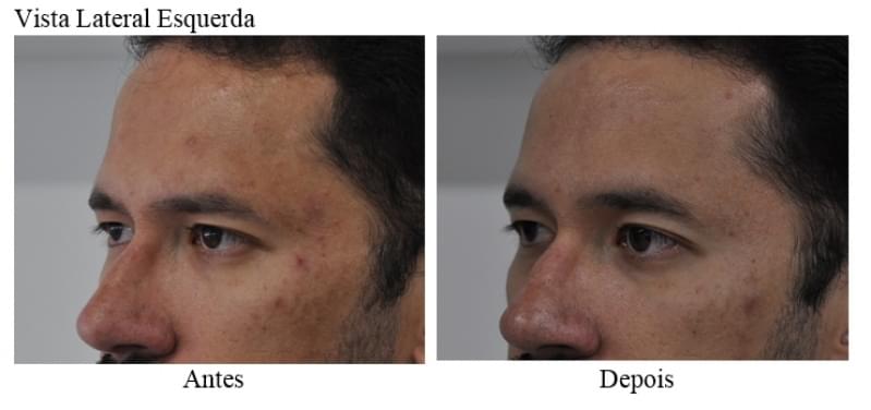 Acupuntura Estética Acne Valor Serraria - Acupuntura Estética Acne