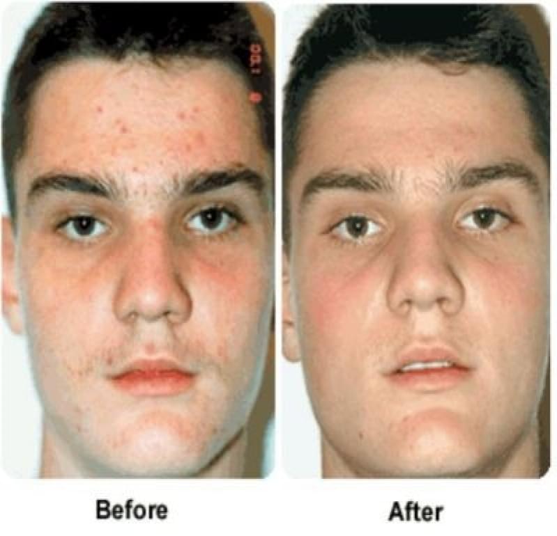 Acupuntura Estética Acne Bairro Silveira - Acupuntura Estética Olheiras