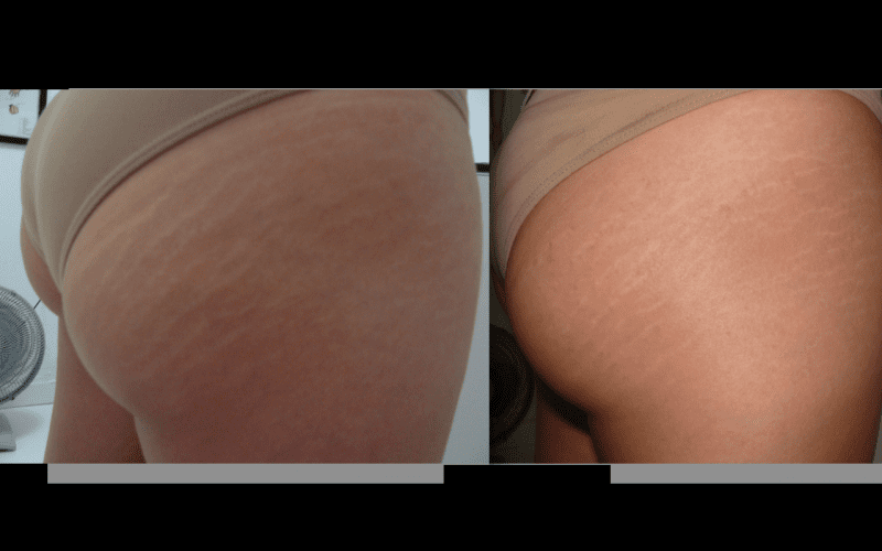 Acupuntura Estética Estrias Preço Jardim Mambae - Acupuntura Estética Redução Abdominal