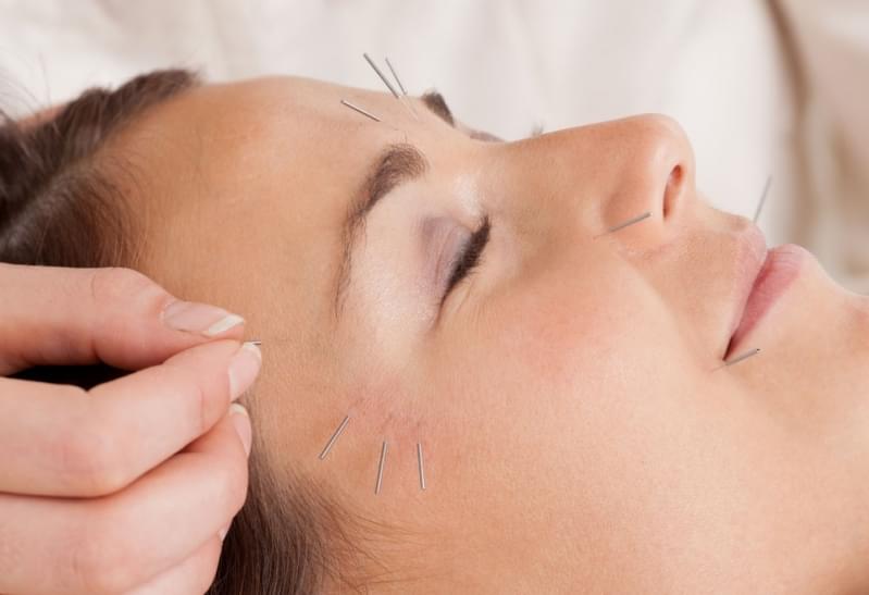 Acupuntura Estética na Face Preço Serraria - Acupuntura Estética Gordura Localizada