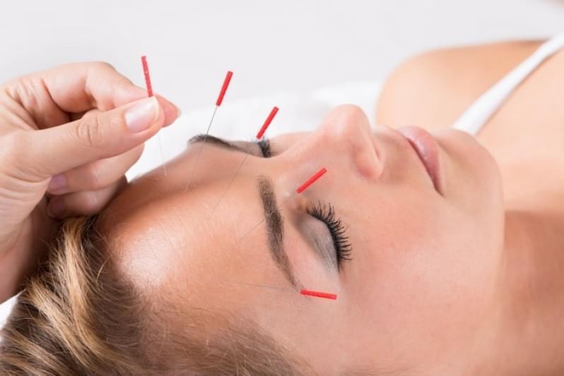 Acupuntura Estética na Face Valor Vila Metalúrgica - Acupuntura Estética para Olheiras