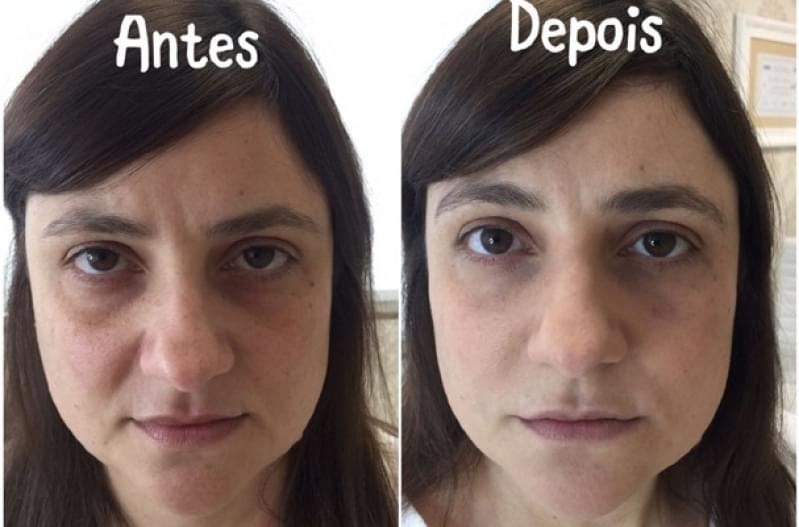 Acupuntura Estética Olheiras Valor Conceição - Acupuntura Estética para Olheiras