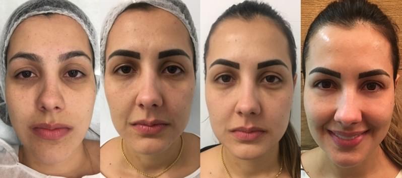 Acupuntura Estética Olheiras Vila Cristiane - Acupuntura Estética Corporal