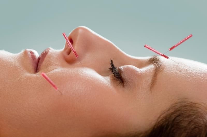 Acupuntura Estética para o Rosto Valor Olímpico - Acupuntura Estética Acne