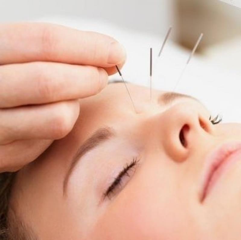 Acupuntura Estética Jardim Mambae - Acupuntura Estética Olheiras