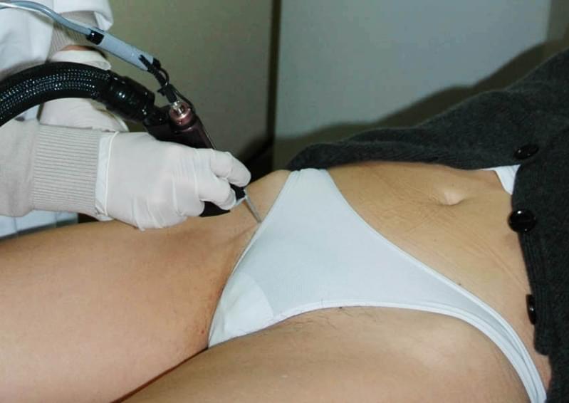 Depilação a Laser da Virilha Jardim Magali - Depilação a Laser Corpo Inteiro