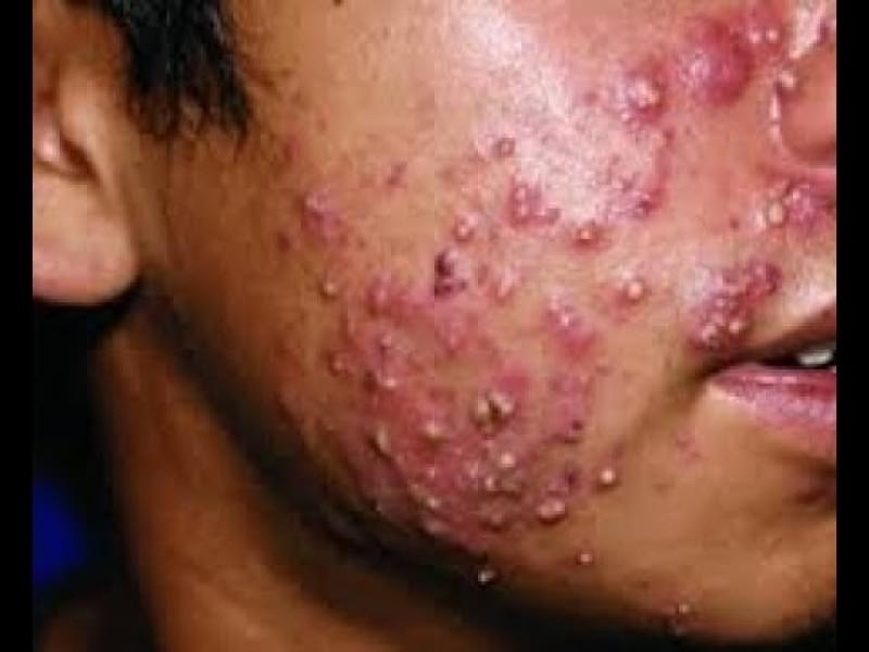 Limpeza de Pele Acne Valor Recreio da Borda do Campo - Limpeza de Pele com Extração