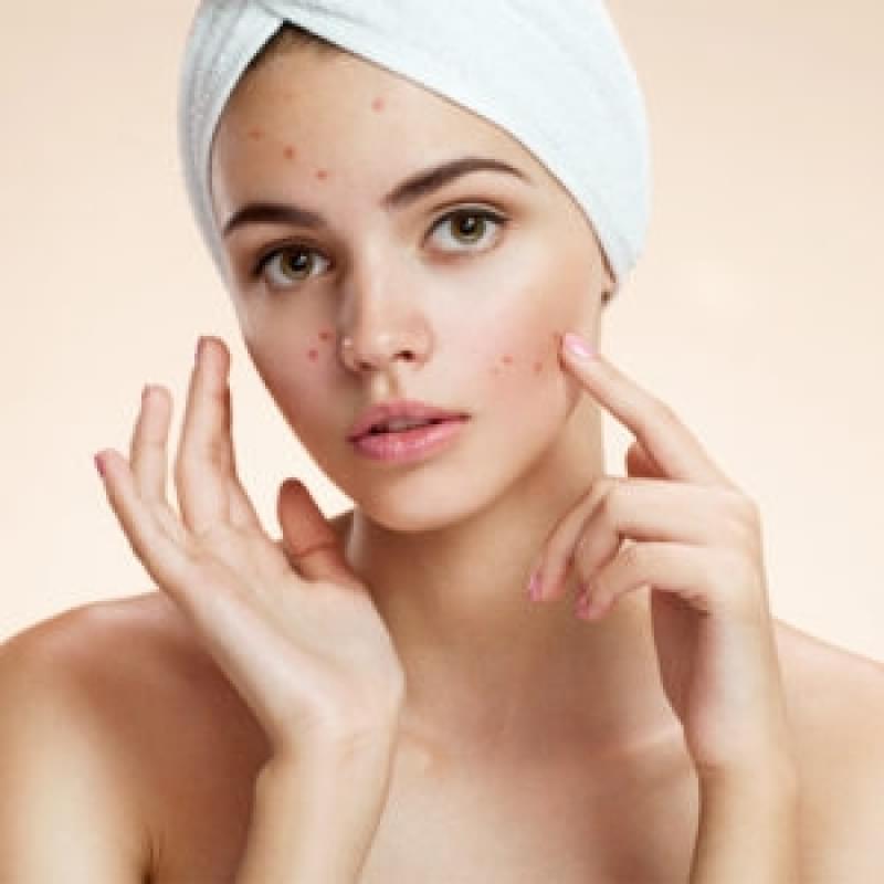 Limpeza de Pele Acne Capuava - Limpeza de Pele para Espinhas