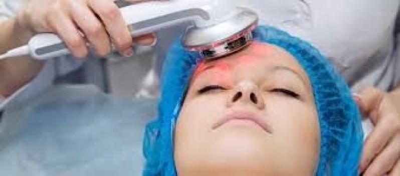 Limpeza de Pele com Laser Vila Júpiter Nova - Limpeza de Pele Dermatologista