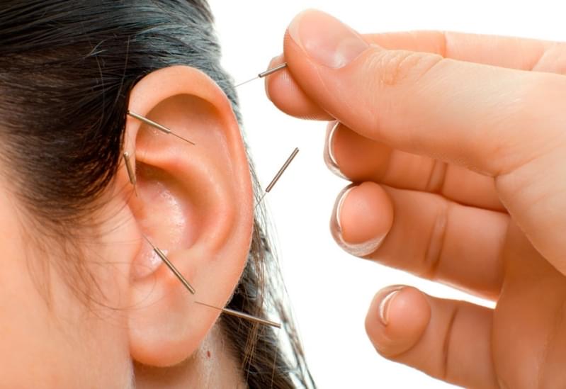 Onde Encontro Acupuntura Auricular Estética Santo André: - Acupuntura Estética para o Rosto