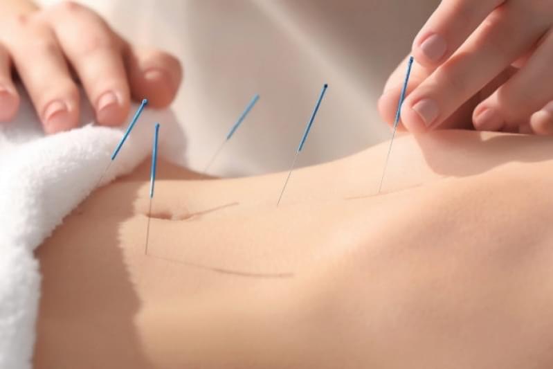 Onde Encontro Acupuntura Estética Abdominal Jardim Las Vegas - Acupuntura Estética Redução Abdominal