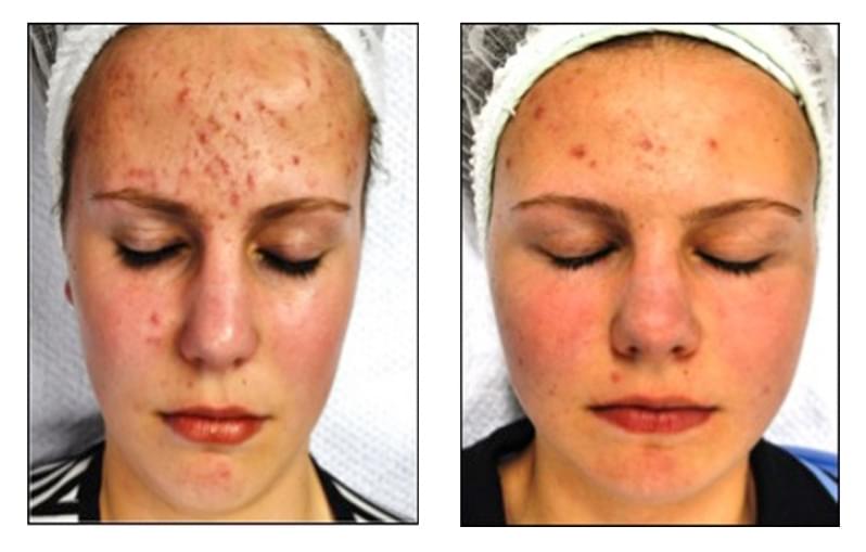 Onde Encontro Acupuntura Estética Acne Cerâmica - Acupuntura Estética Corporal