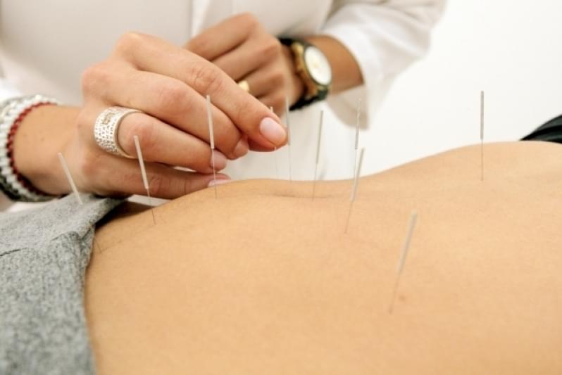 Onde Encontro Acupuntura Estética Redução Abdominal Ipiranga - Acupuntura Estética Corporal