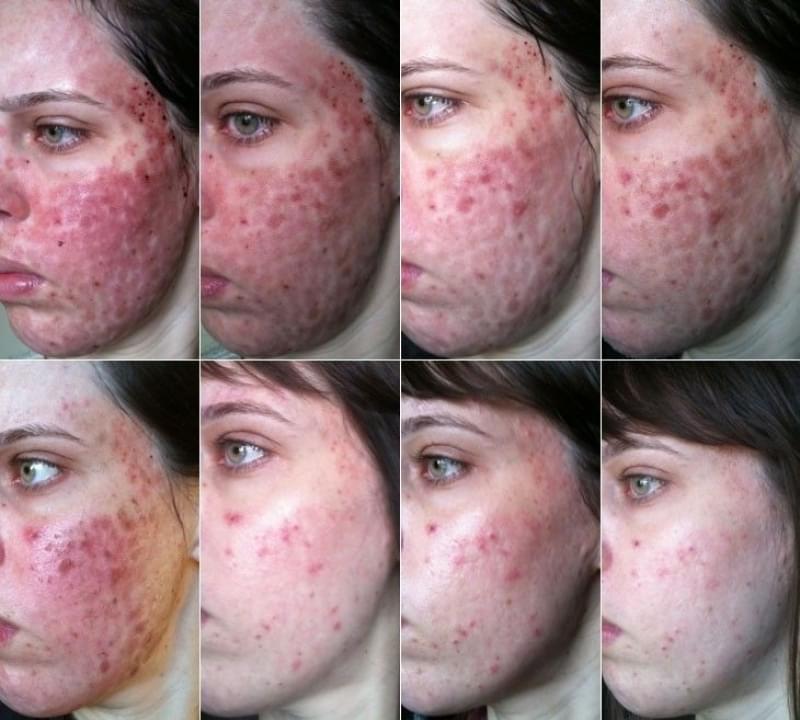 Onde Encontro Limpeza de Pele para Espinhas Figueiras - Limpeza de Pele Acne