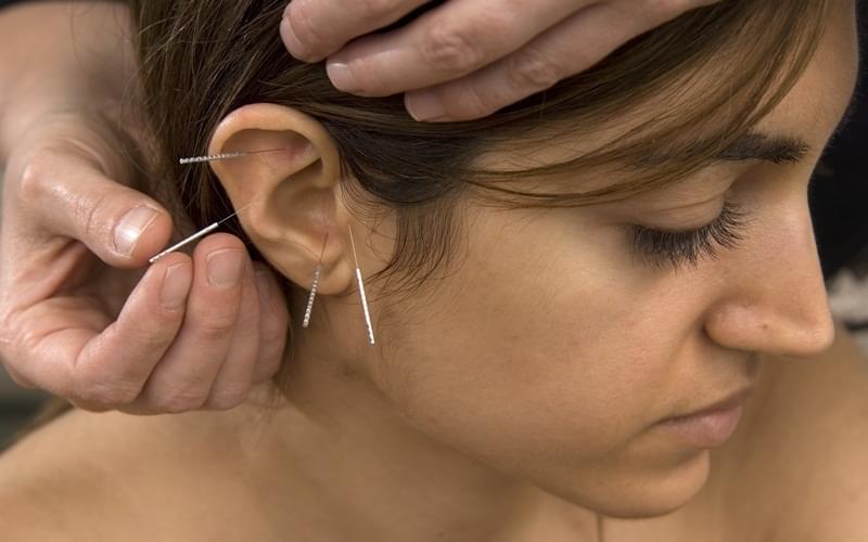 Quanto Custa Acupuntura Auricular Estética Jardim Nair Conceição - Acupuntura Estética para Olheiras