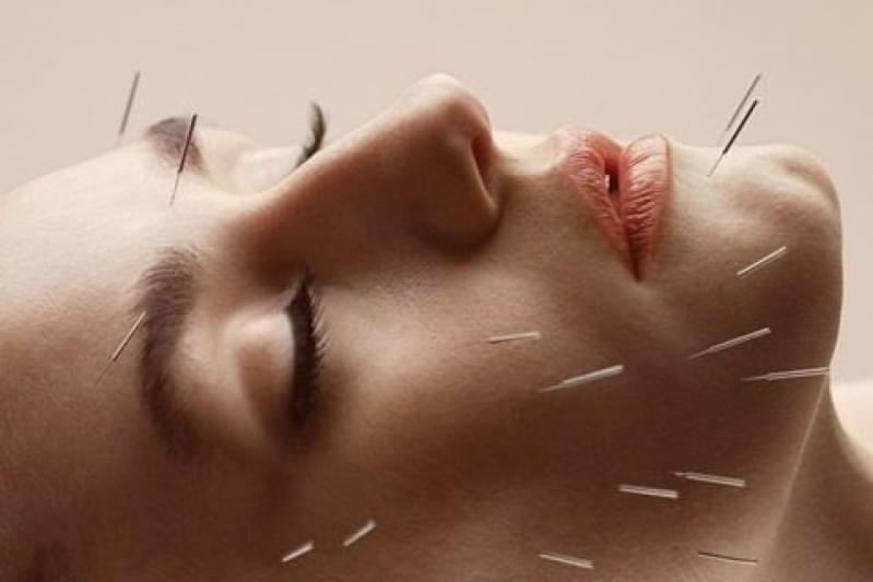 Quanto Custa Acupuntura Estética na Face Barcelona - Acupuntura Estética Corporal