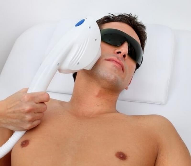 Quanto Custa Depilação a Laser Barba Vila Alpina - Depilação a Laser para Homens