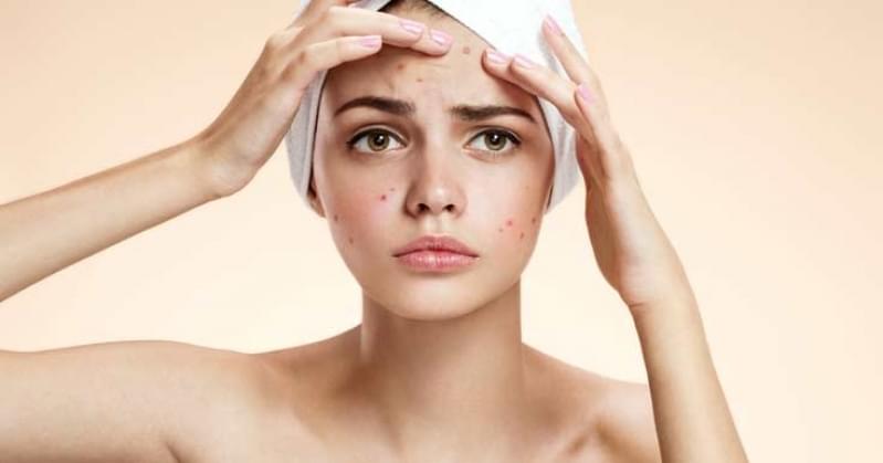 Quanto Custa Limpeza de Pele Acne Vila Linda - Limpeza de Pele para Espinhas