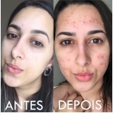 acupuntura estética acne preço Vila Santa Rita