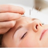 acupuntura estética Figueiras