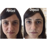 Acupuntura Estética para Olheiras