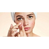 limpeza de pele acne preço Tamanduateí 4