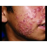 limpeza de pele acne valor Condomínio Maracanã