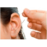 onde encontro acupuntura auricular estética Itapeva